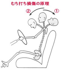 むちうち損傷６つの型分類②